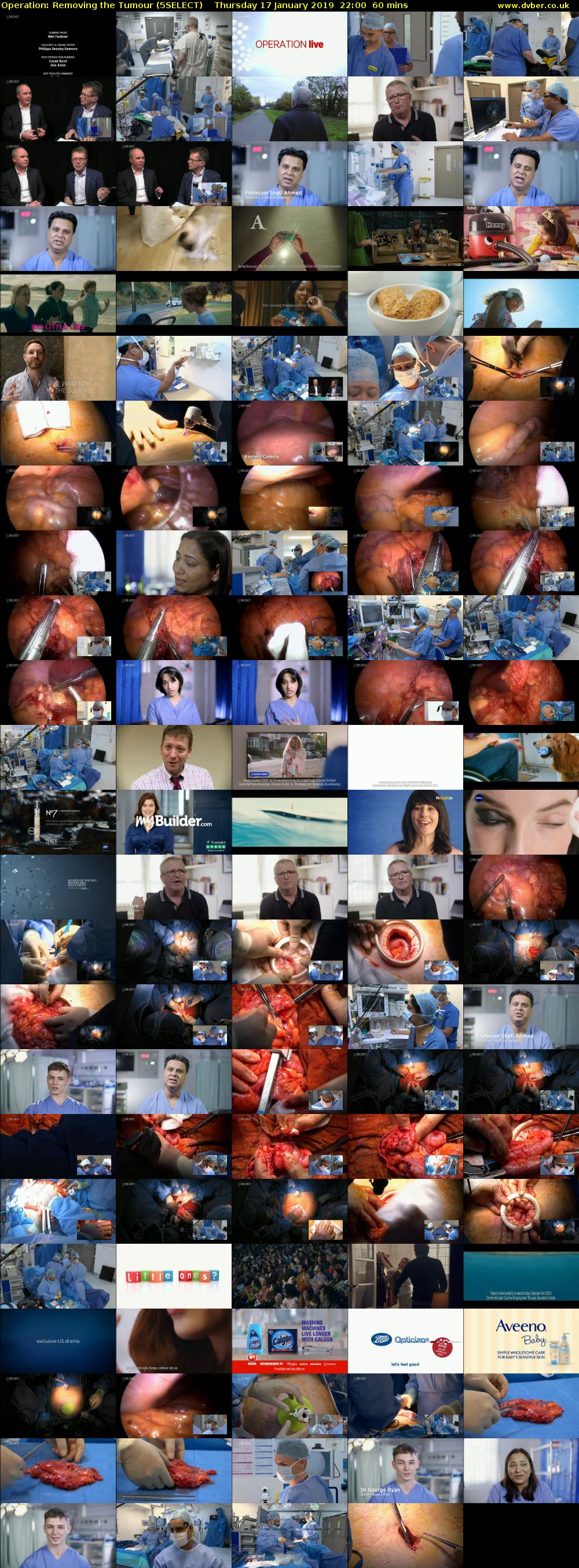 Operation: Removing the Tumour (5SELECT) Thursday 17 January 2019 22:00 - 23:00
