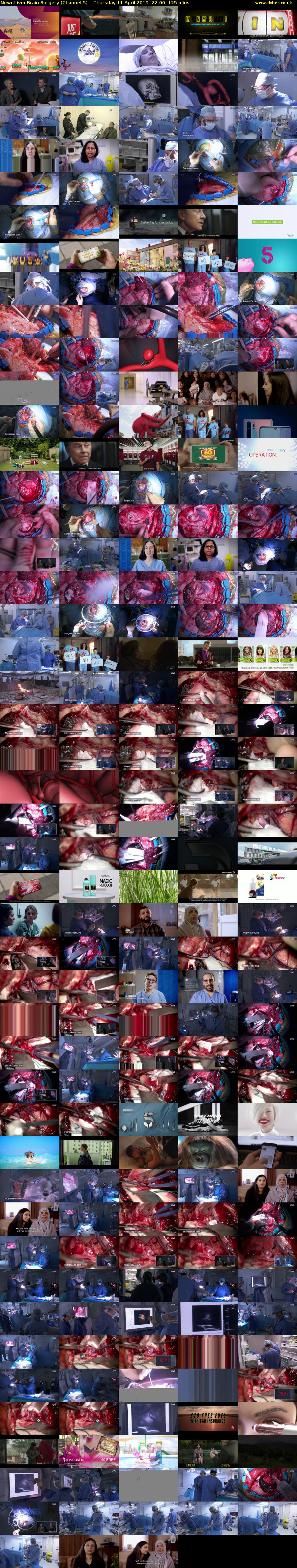 Live: Brain Surgery (Channel 5) Thursday 11 April 2019 22:00 - 00:05