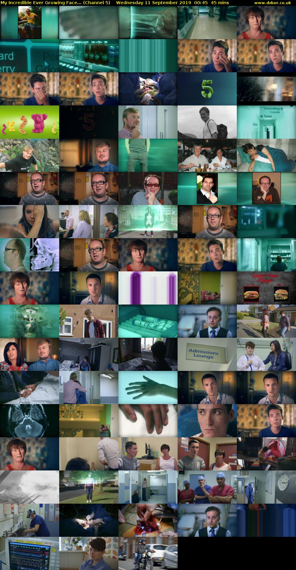 My Incredible Ever Growing Face... (Channel 5) Wednesday 11 September 2019 00:45 - 01:30