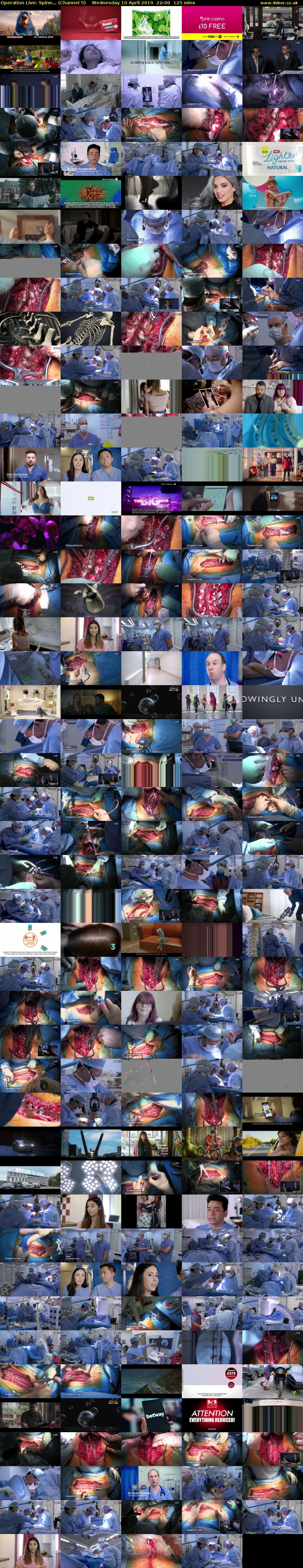 Operation Live: Spine... (Channel 5) Wednesday 10 April 2019 22:00 - 00:05