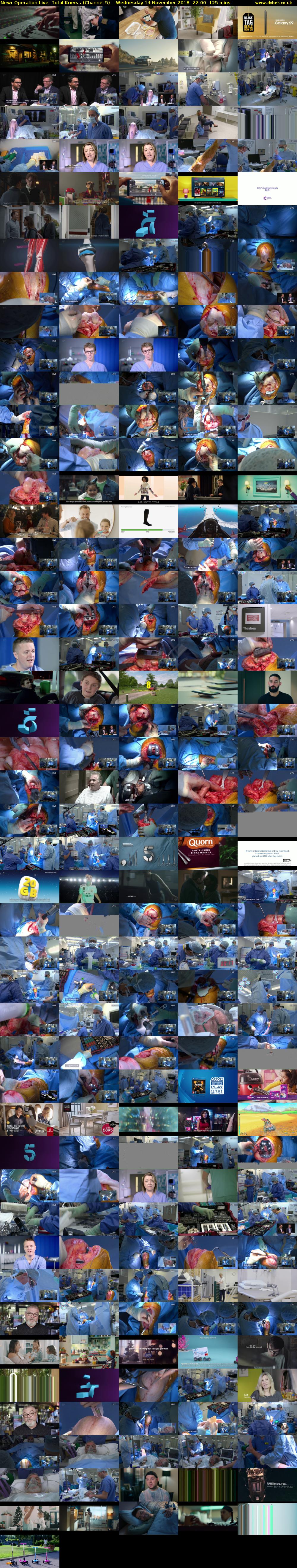 Operation Live: Total Knee... (Channel 5) Wednesday 14 November 2018 22:00 - 00:05