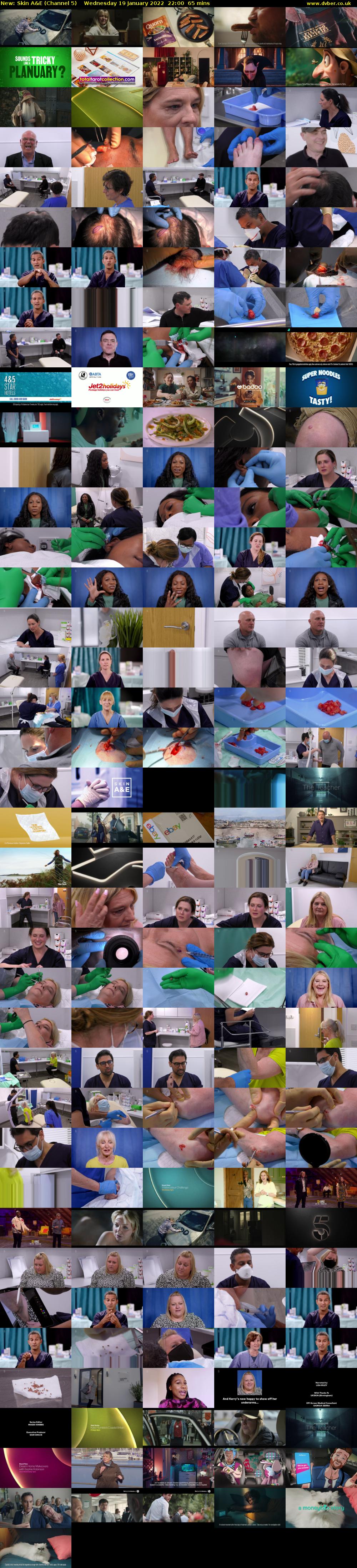 Skin A&E (Channel 5) Wednesday 19 January 2022 22:00 - 23:05