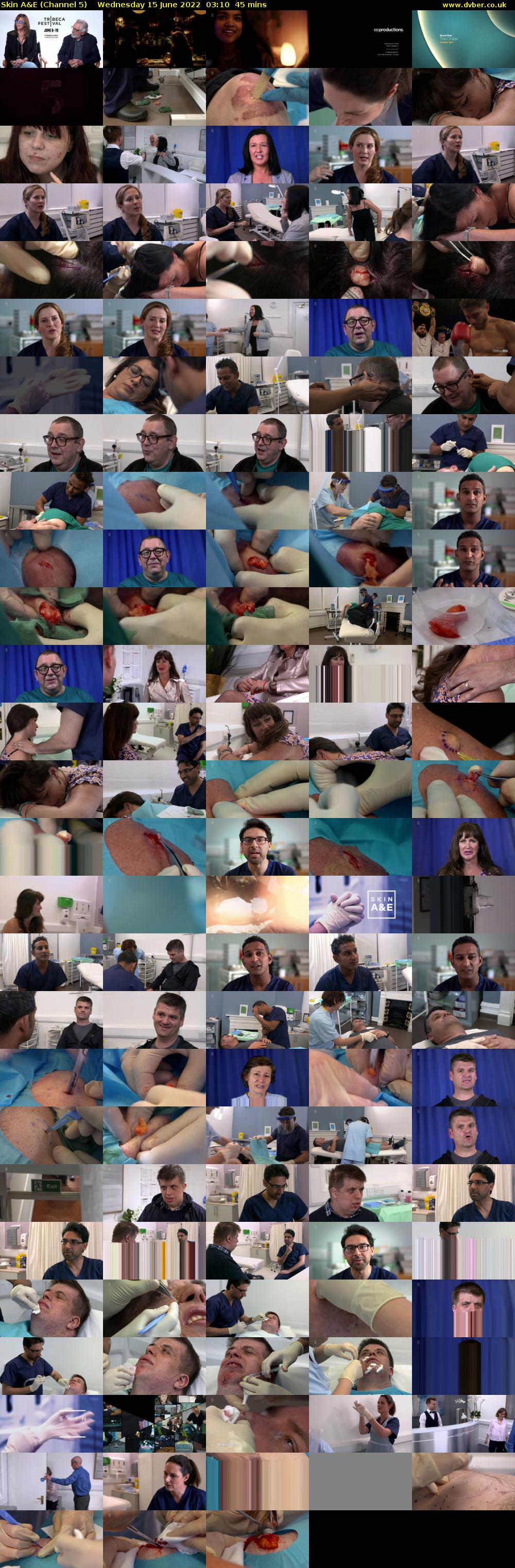 Skin A&E (Channel 5) Wednesday 15 June 2022 03:10 - 03:55