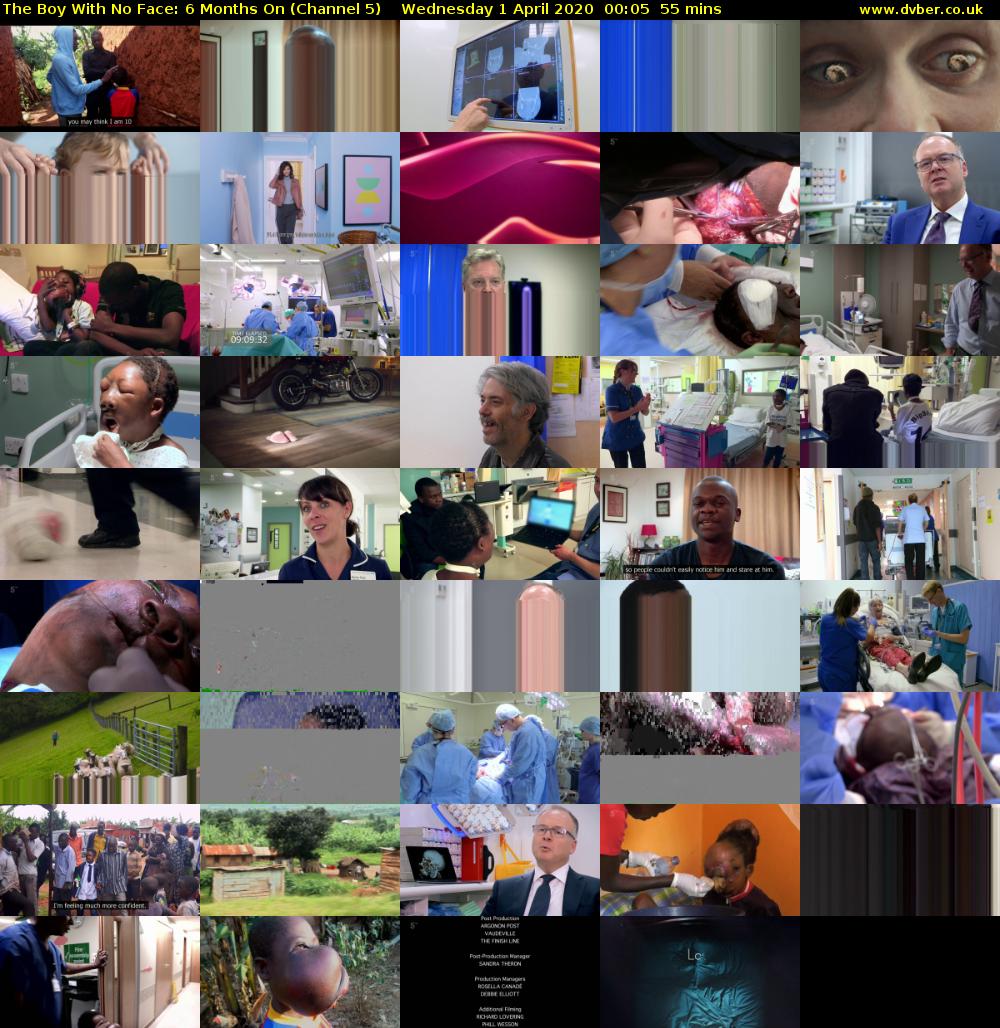 The Boy With No Face: 6 Months On (Channel 5) Wednesday 1 April 2020 00:05 - 01:00