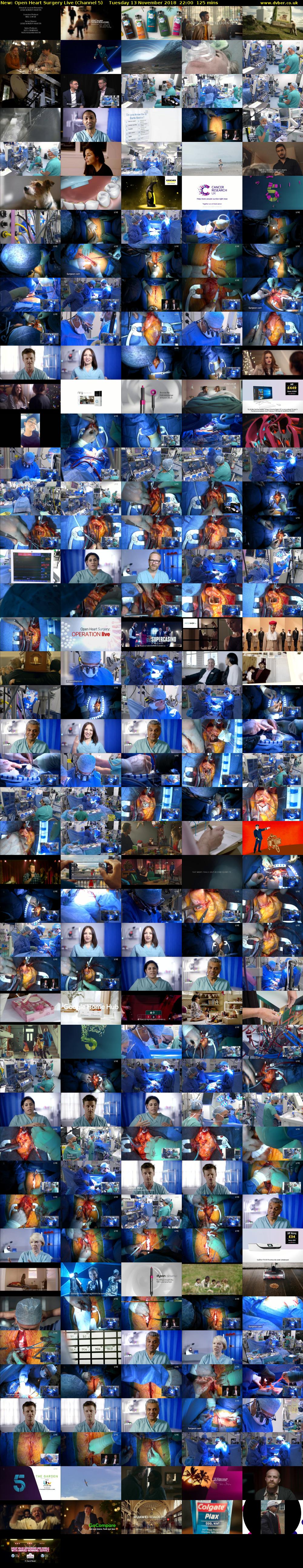 Open Heart Surgery Live (Channel 5) Tuesday 13 November 2018 22:00 - 00:05