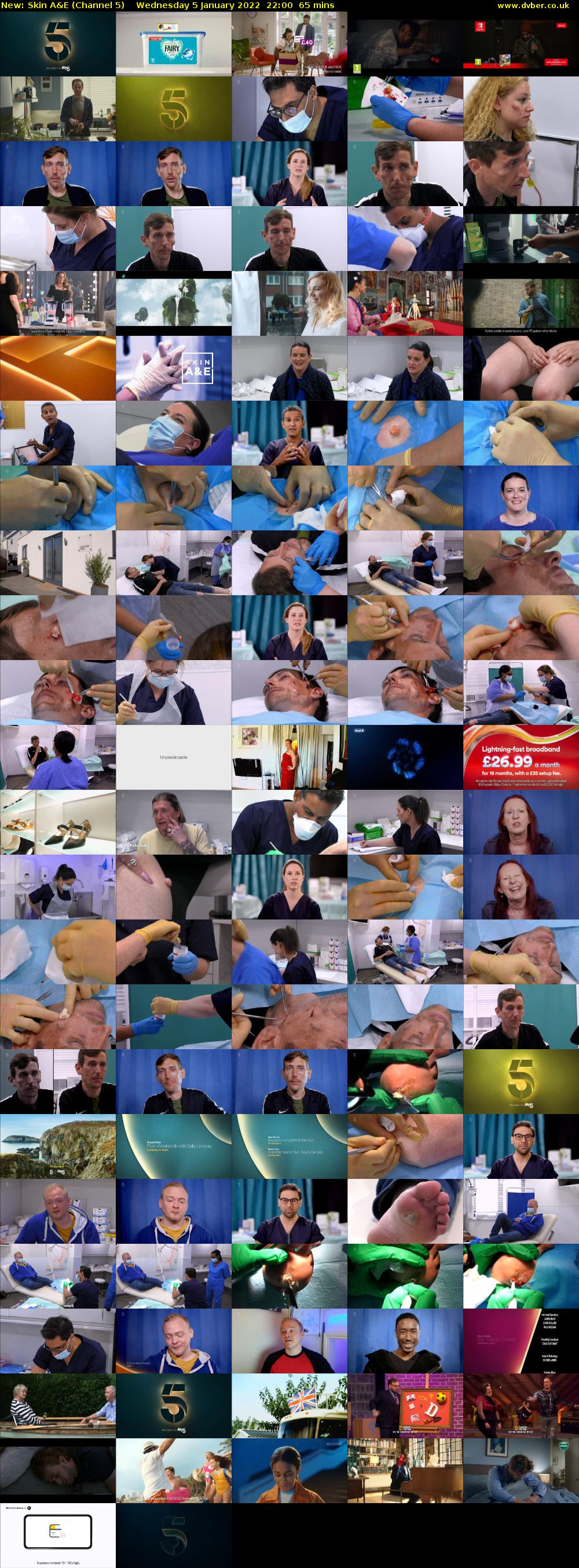 Skin A&E (Channel 5) Wednesday 5 January 2022 22:00 - 23:05