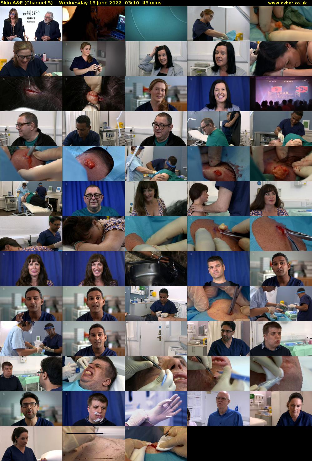 Skin A&E (Channel 5) Wednesday 15 June 2022 03:10 - 03:55