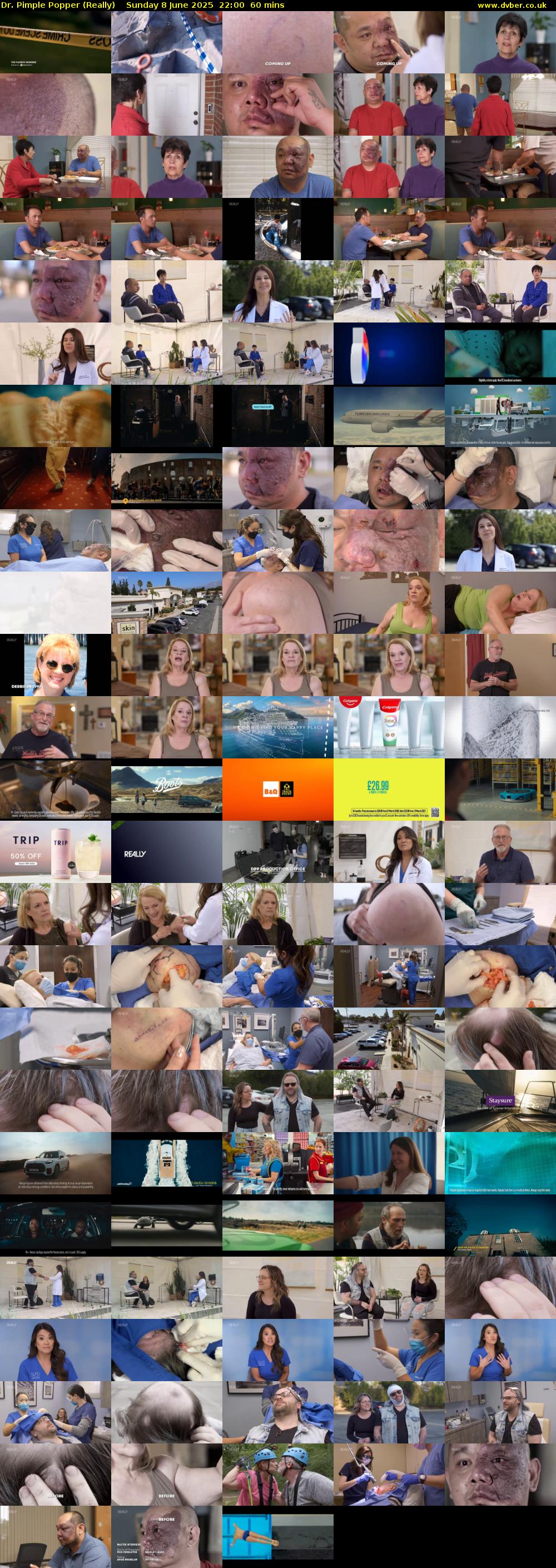 Dr. Pimple Popper (Really) Sunday 8 June 2025 22:00 - 23:00