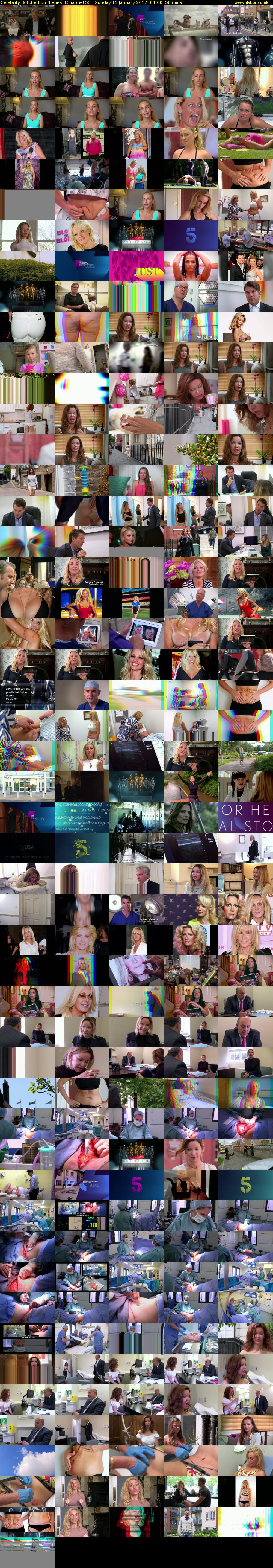 Celebrity Botched Up Bodies  (Channel 5) Sunday 15 January 2017 04:00 - 04:50