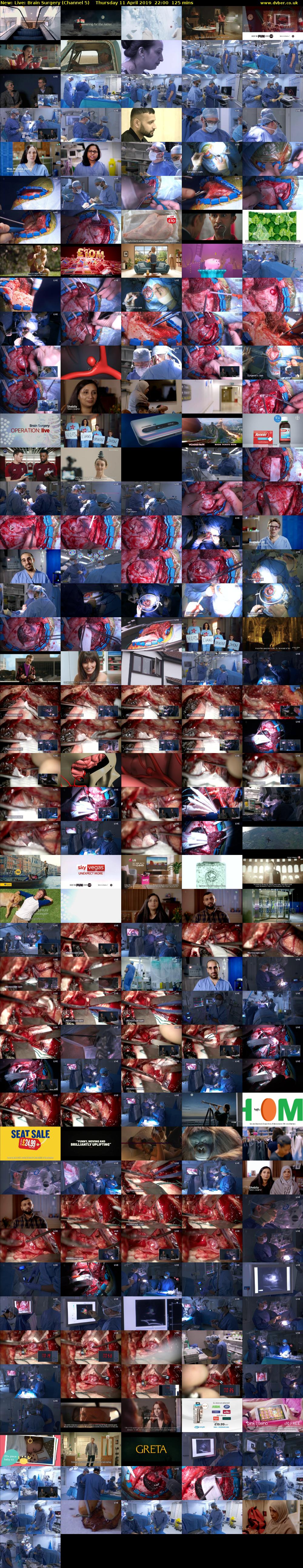 Live: Brain Surgery (Channel 5) Thursday 11 April 2019 22:00 - 00:05