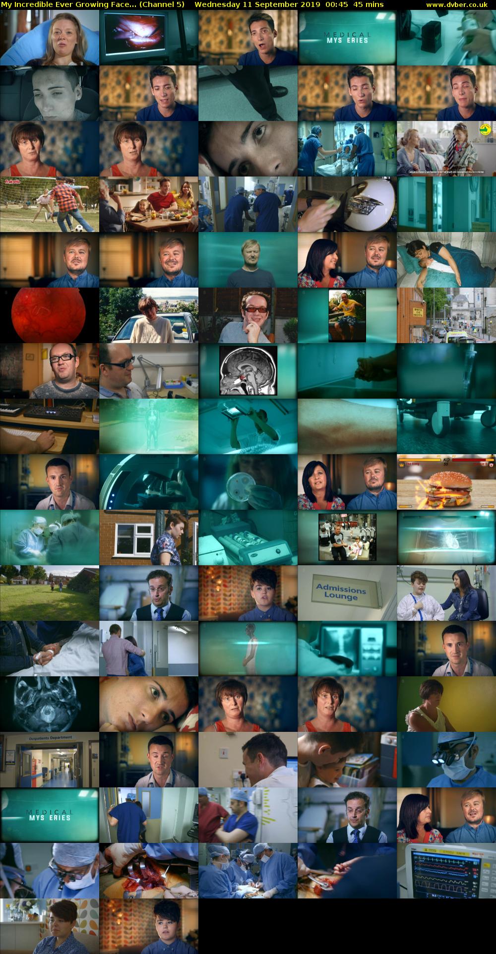 My Incredible Ever Growing Face... (Channel 5) Wednesday 11 September 2019 00:45 - 01:30
