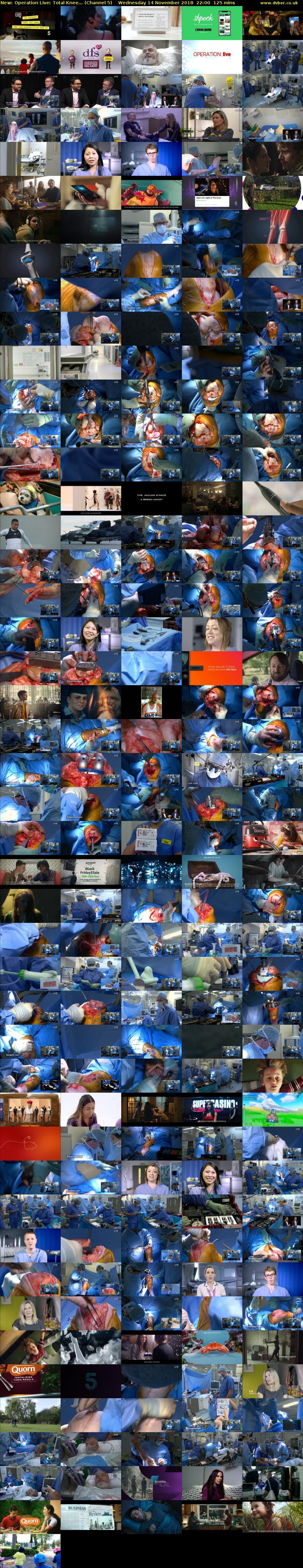 Operation Live: Total Knee... (Channel 5) Wednesday 14 November 2018 22:00 - 00:05