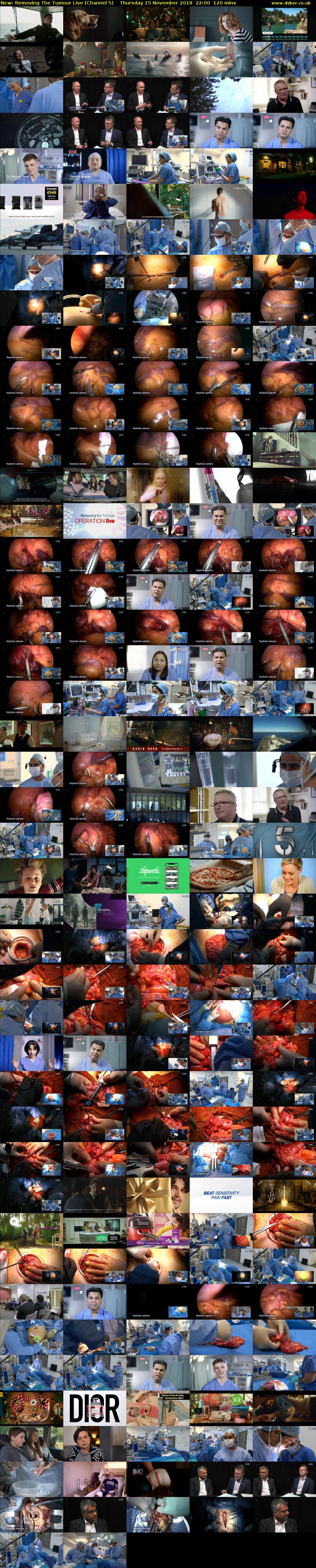 Removing The Tumour Live (Channel 5) Thursday 15 November 2018 22:00 - 00:00